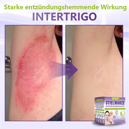 🦅GFOUK® Lösliches Mikronadel-Pflaster zur Entfernung von Hautanhängseln auf Pflanzenbasis