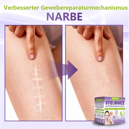 🦅GFOUK® Lösliches Mikronadel-Pflaster zur Entfernung von Hautanhängseln auf Pflanzenbasis