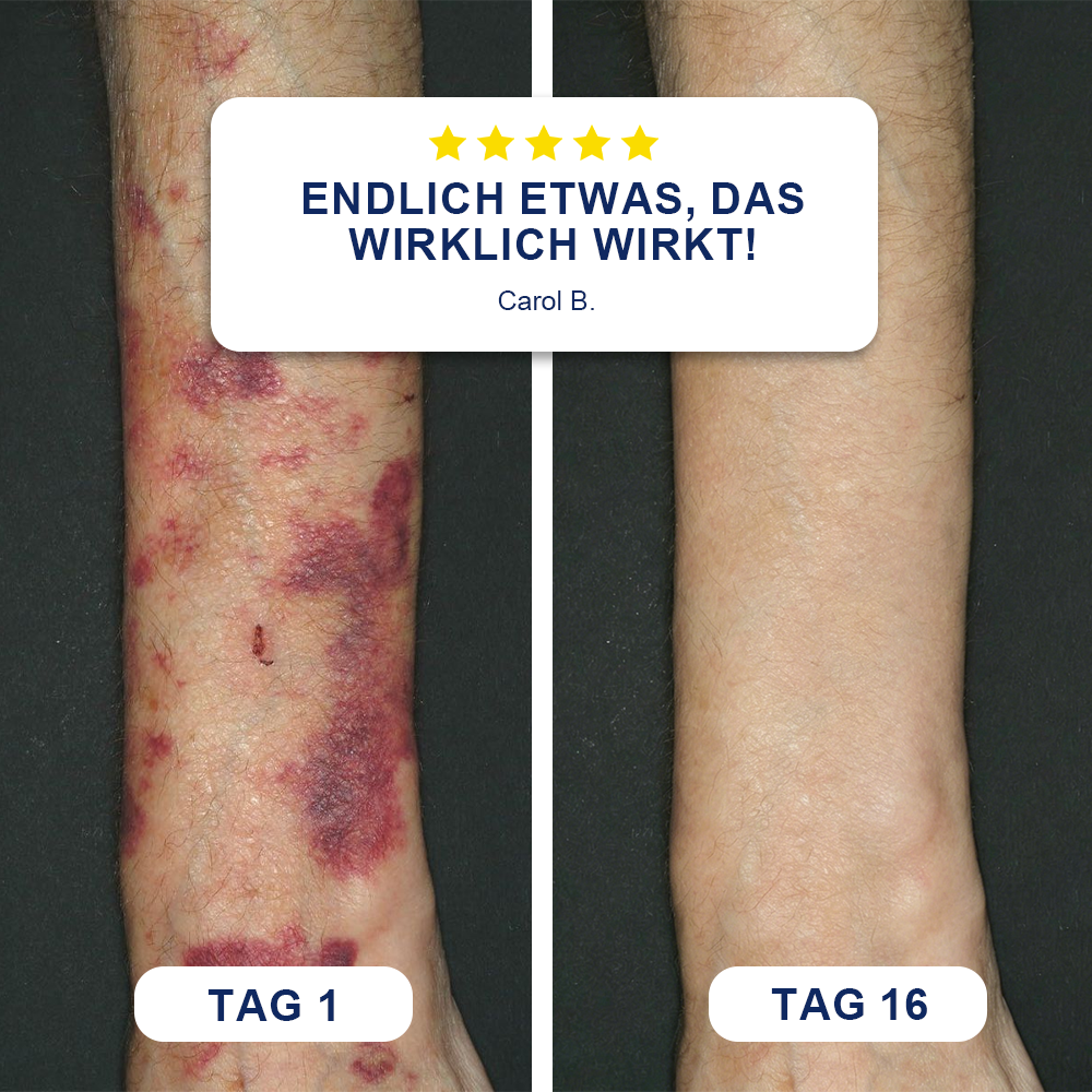 🦅Evolvion® Creme zur Bluterguss-Reparatur & Hautstärkung