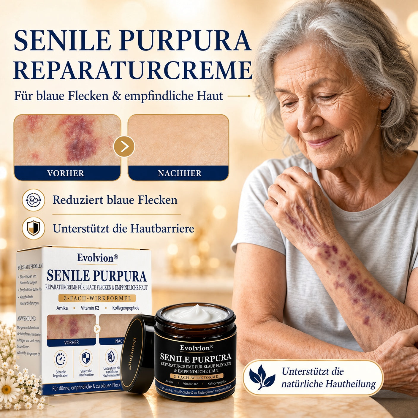 🦅Evolvion® Pflegecreme bei seniler Purpura, Blutergüssen & fragiler Haut