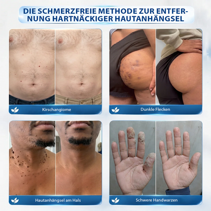 Hergestellt und versandt aus Deutschland ✨Evolvion® 𝟕-𝐓𝐚𝐠𝐞 Hautanhängsel- & Fleckenentferner (𝟕-𝐃𝐚𝐲 𝐒𝐤𝐢𝐧 𝐓𝐚𝐠 & 𝐒𝐩𝐨𝐭 𝐄𝐫𝐚𝐬𝐞𝐫) – Schmerzfreier & narbenfreier fortschrittlicher Roll-on-Stift zur Entfernung von Hautunreinheiten