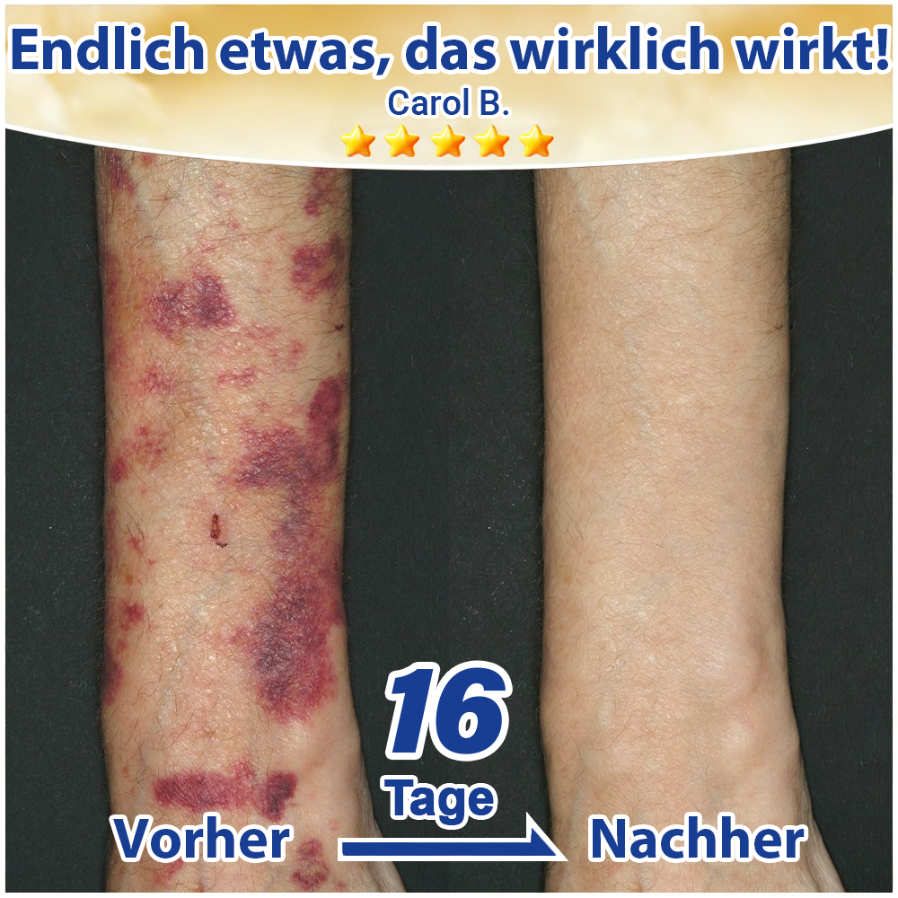 🦄💋Evolvion® Pflegecreme bei seniler Purpura, Blutergüssen & fragiler Haut💕💕💕