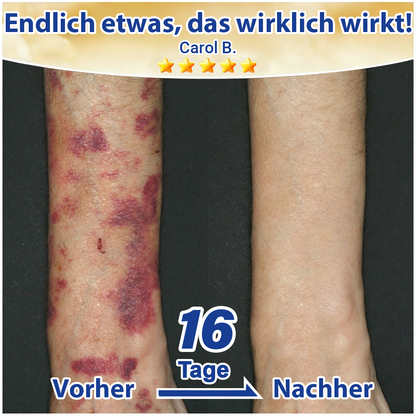 🦄💋Evolvion® Pflegecreme bei seniler Purpura, Blutergüssen & fragiler Haut💕💕💕