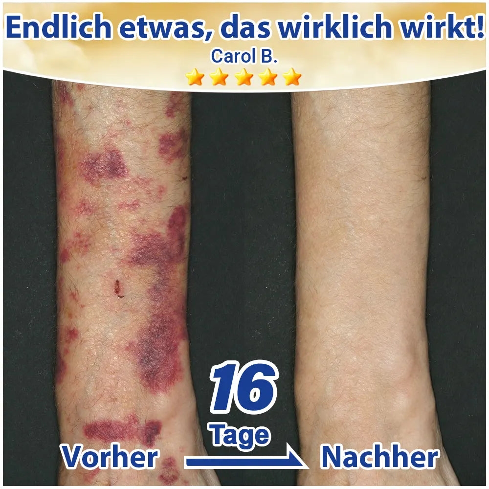 🦅Evolvion® Pflegecreme bei seniler Purpura, Blutergüssen & fragiler Haut