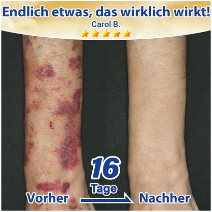 🦅Evolvion® Pflegecreme bei seniler Purpura, Blutergüssen & fragiler Haut