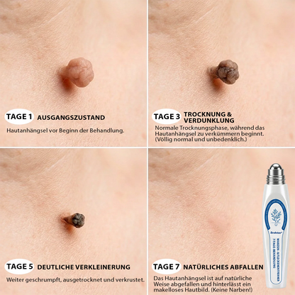 Hergestellt und versandt aus Deutschland ✨Evolvion® 𝟕-𝐓𝐚𝐠𝐞 Hautanhängsel- & Fleckenentferner (𝟕-𝐃𝐚𝐲 𝐒𝐤𝐢𝐧 𝐓𝐚𝐠 & 𝐒𝐩𝐨𝐭 𝐄𝐫𝐚𝐬𝐞𝐫) – Schmerzfreier & narbenfreier fortschrittlicher Roll-on-Stift zur Entfernung von Hautunreinheiten