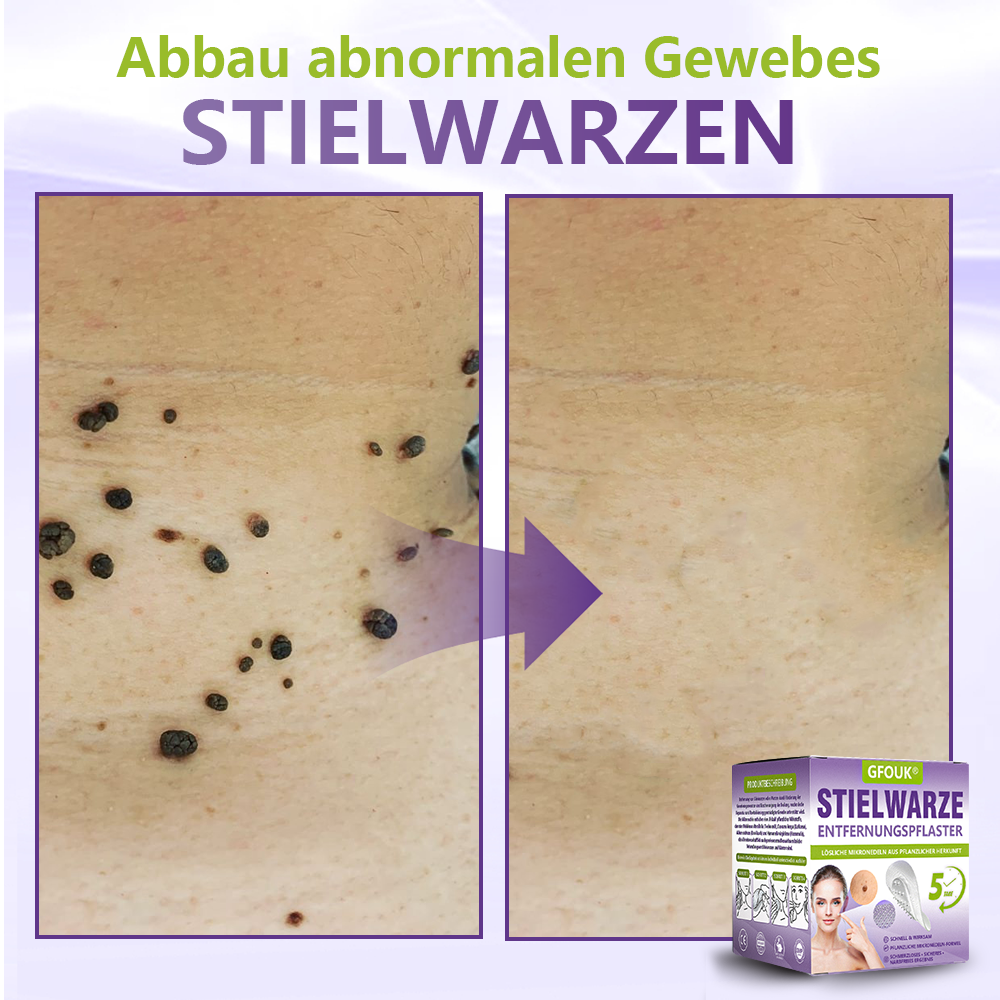 🦅GFOUK® Lösliches Mikronadel-Pflaster zur Entfernung von Hautanhängseln auf Pflanzenbasis