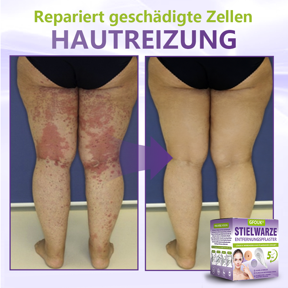 🦅GFOUK® Lösliches Mikronadel-Pflaster zur Entfernung von Hautanhängseln auf Pflanzenbasis