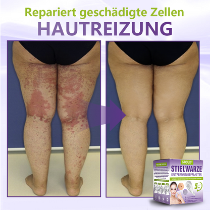 🦅GFOUK® Lösliches Mikronadel-Pflaster zur Entfernung von Hautanhängseln auf Pflanzenbasis