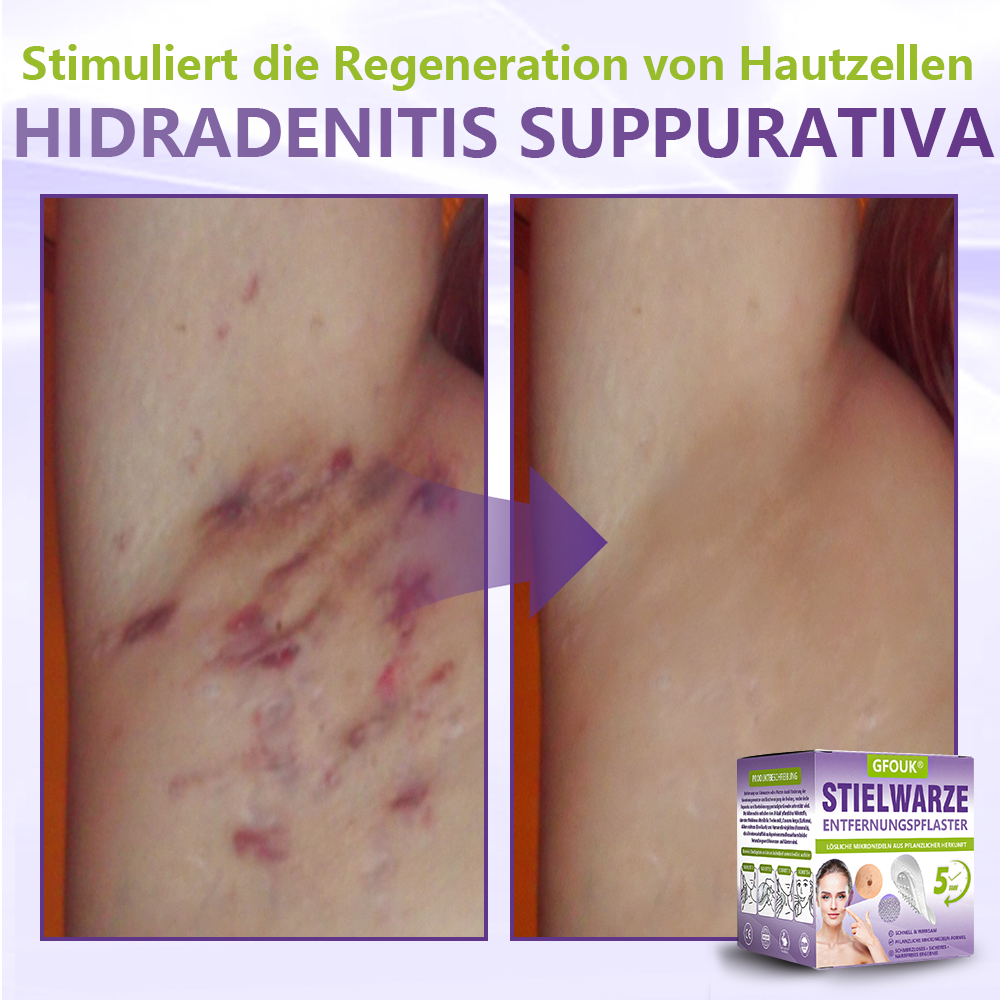 🦅GFOUK® Lösliches Mikronadel-Pflaster zur Entfernung von Hautanhängseln auf Pflanzenbasis
