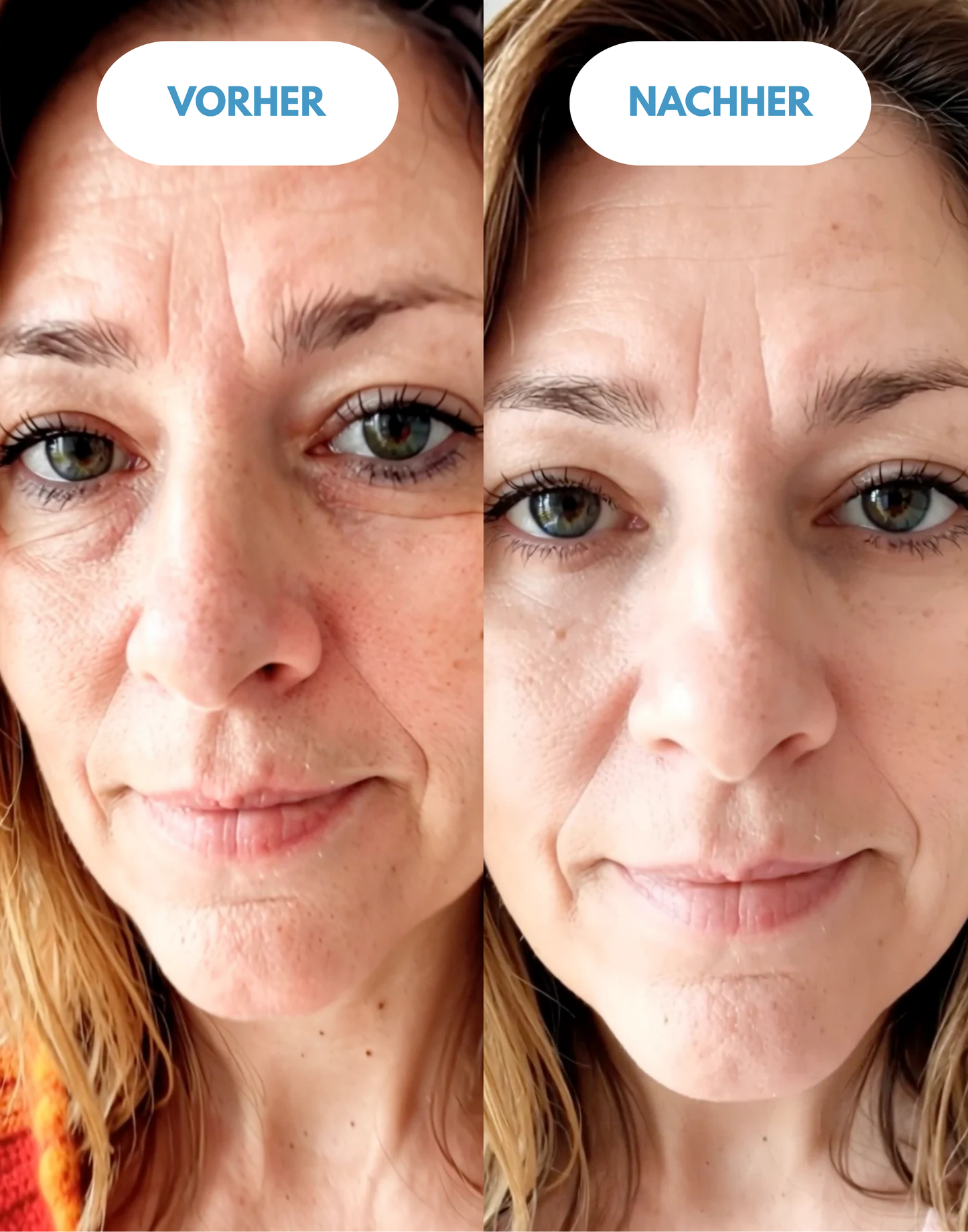 🔬Avasoma® Straffen & Erneuern - Wärmetherapie gegen Tränensäcke, Augenringe und Falten